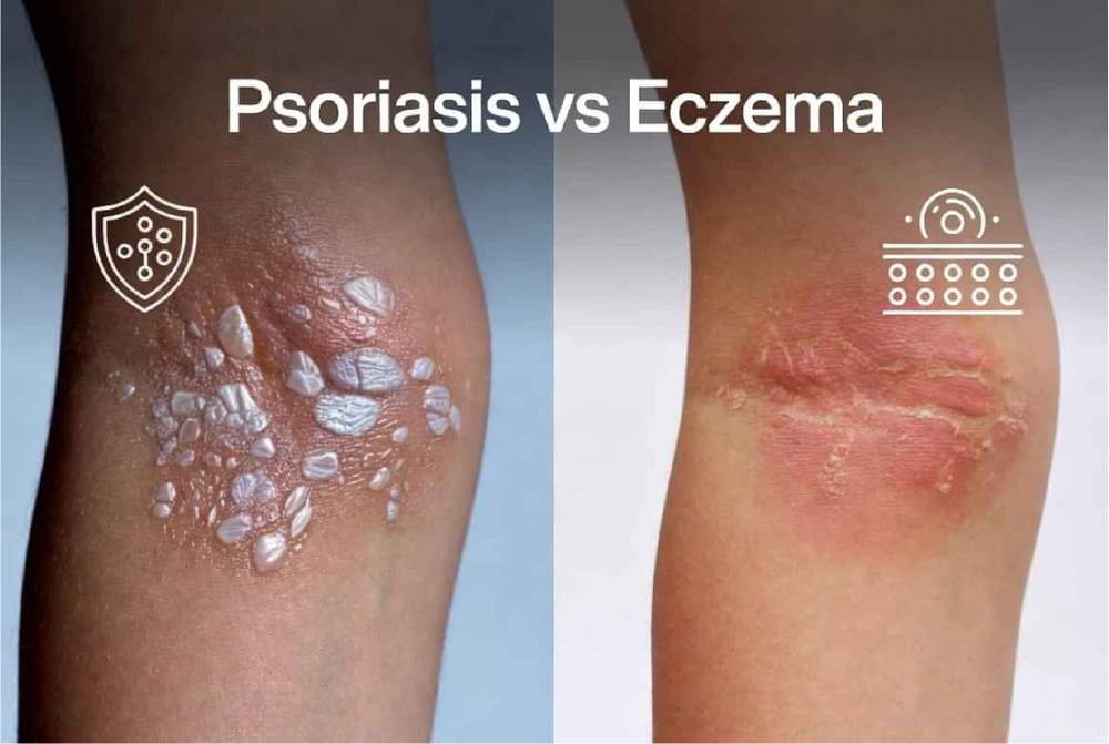 Psoriasis vs Eczema: Complete Guide to Symptoms, Causes & Treatment